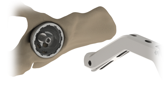 Enztec Modular Offset Cup Impactor X XR attached detach B