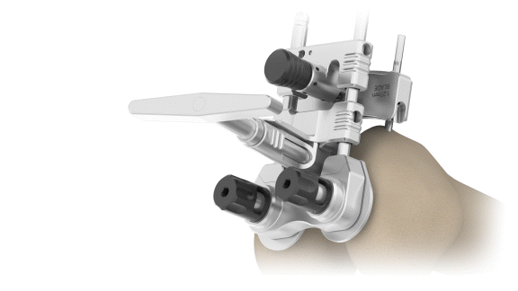 ENZTEC AdjustableDistalFemoralAlignmentGuide OnOffBone3